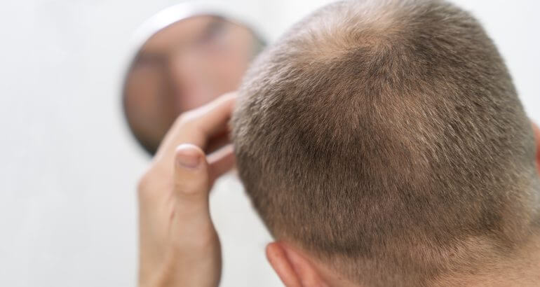 Saç Dökülmesi Neden Olur, Nasıl Engellenir?