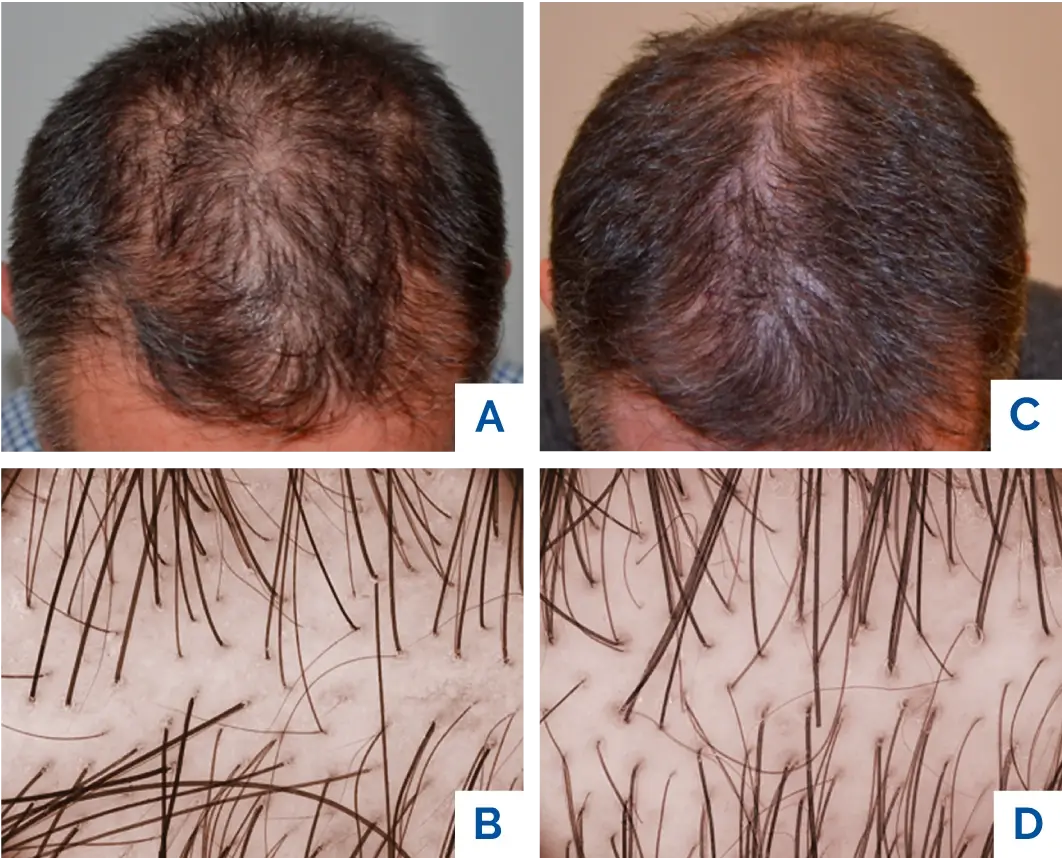 Tricopat saç dökülmesi tedavisi uygulaması — iğnesiz ve ağrısız bir işlemdir