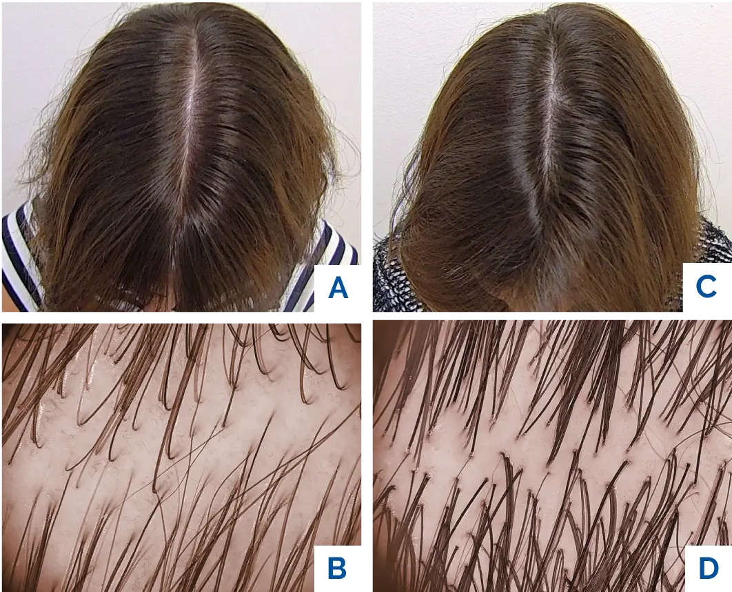 Tricopat cihazı — Dr. Cansu Şahin kliniğinde kullanılan TRICOGENESI protokolü