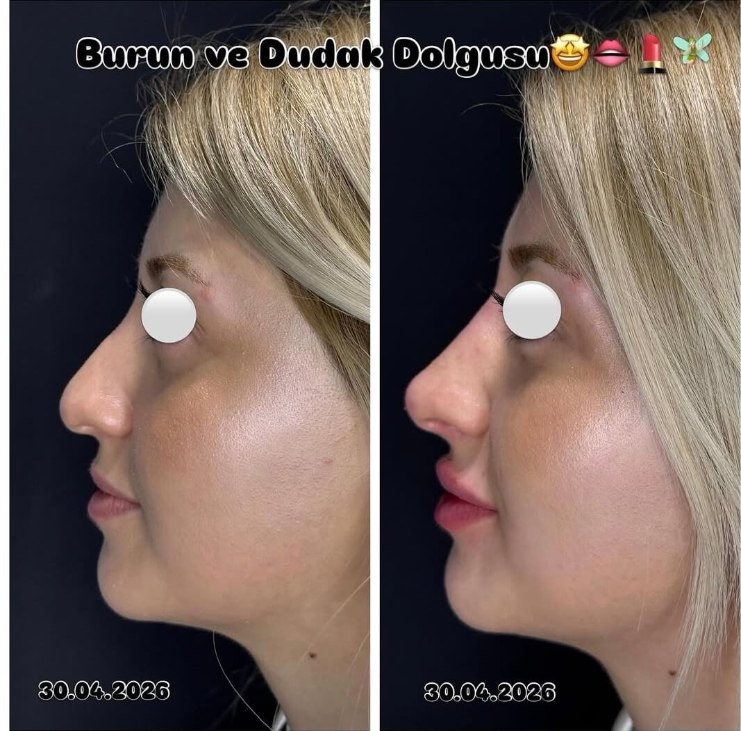 Ameliyatsız burun ve dudak dolgusu uygulaması — Dr. Cansu Şahin Dermatoloji