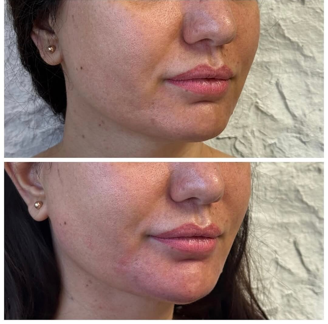Ameliyatsız çene dolgusu uygulaması — Dr. Cansu Şahin Dermatoloji