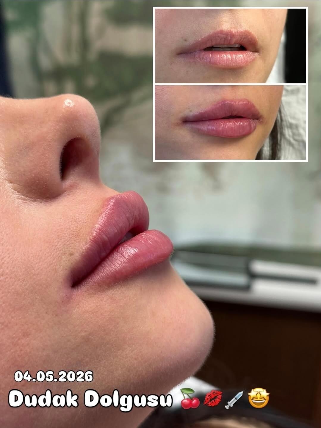 Ameliyatsız dudak dolgusu yan profil — Dr. Cansu Şahin Dermatoloji