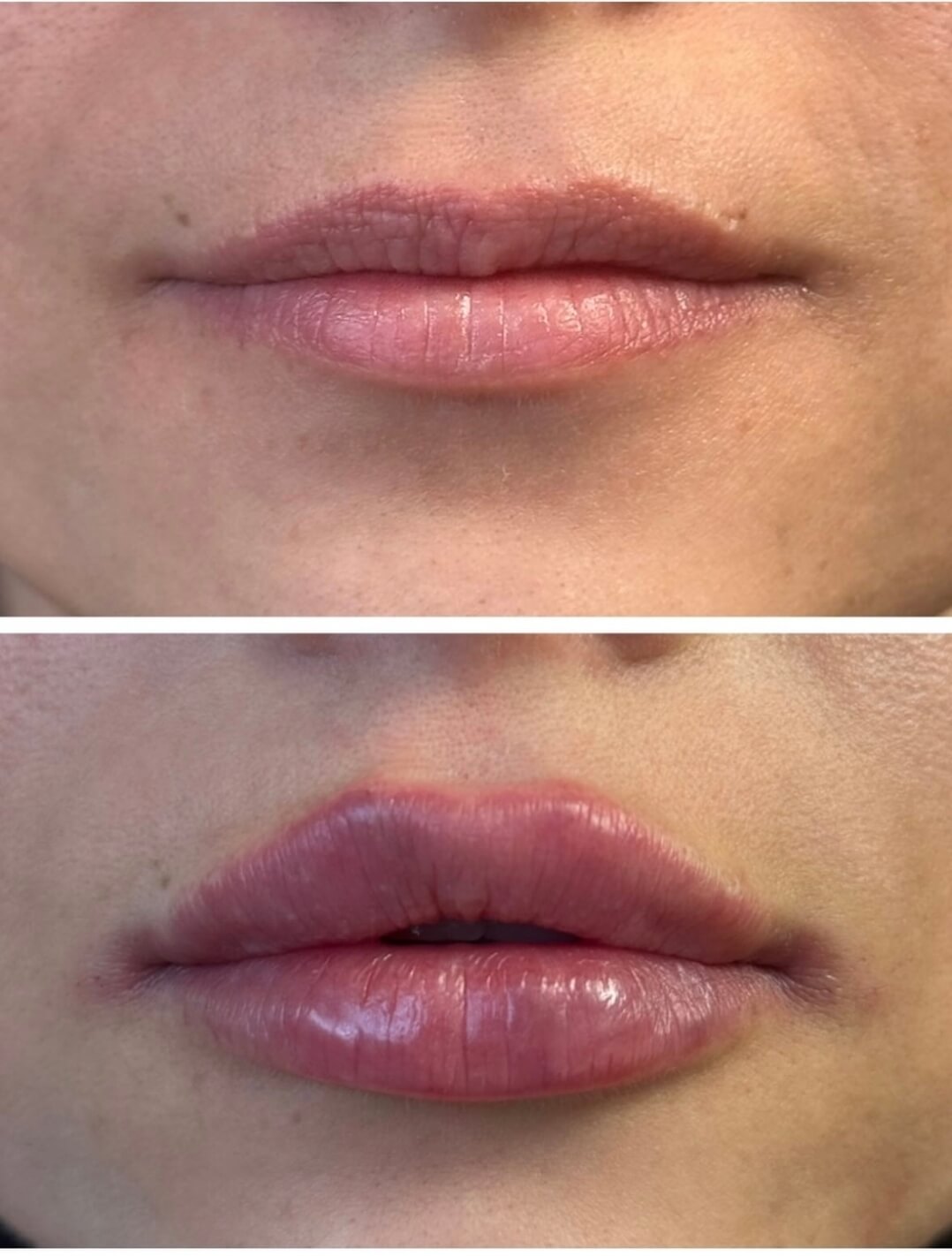 Ameliyatsız dudak dolgusu uygulaması — Dr. Cansu Şahin Dermatoloji