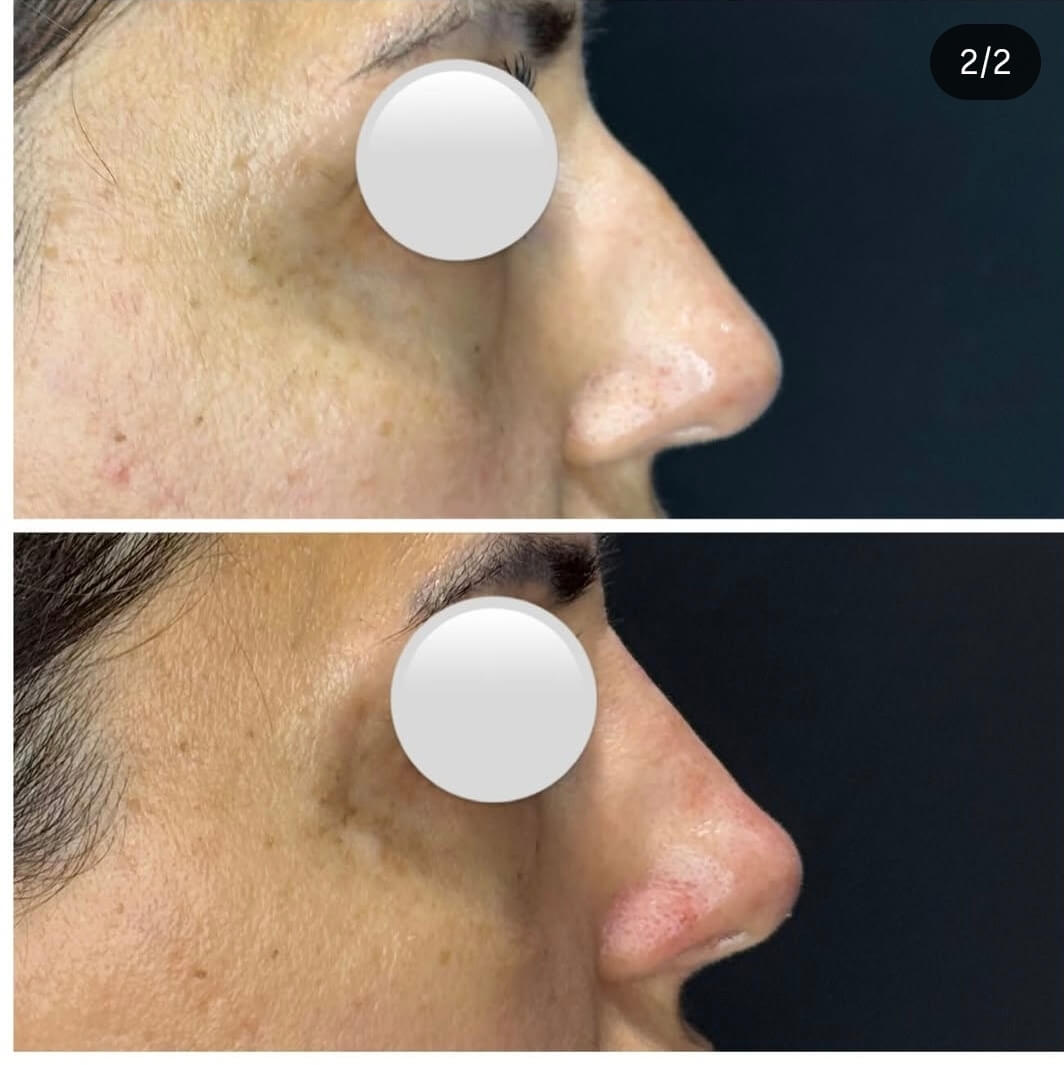 Burun dolgusu — Dr. Cansu Şahin Dermatoloji