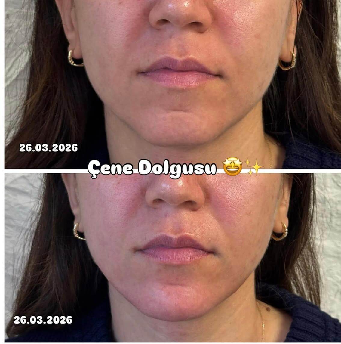 Çene ve jawline dolgusu — Dr. Cansu Şahin Dermatoloji