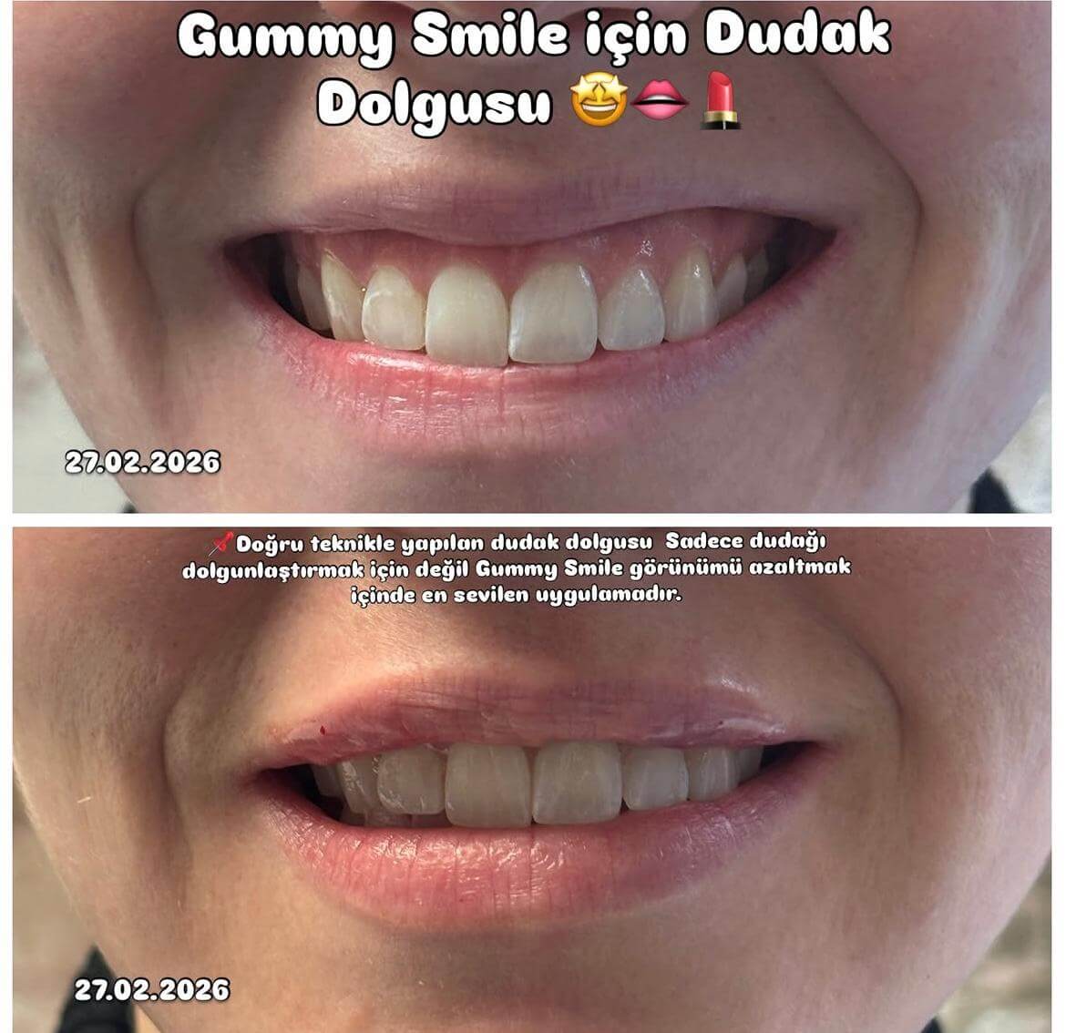 Dudak dolgusu ve gummy smile uygulaması — Dr. Cansu Şahin Dermatoloji