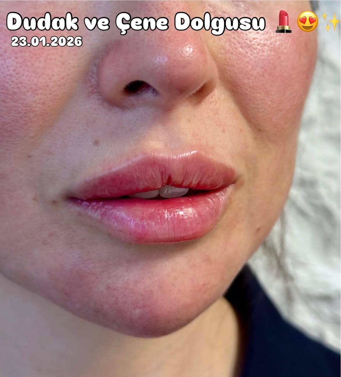 Dudak ve çene dolgusu — Dr. Cansu Şahin Dermatoloji