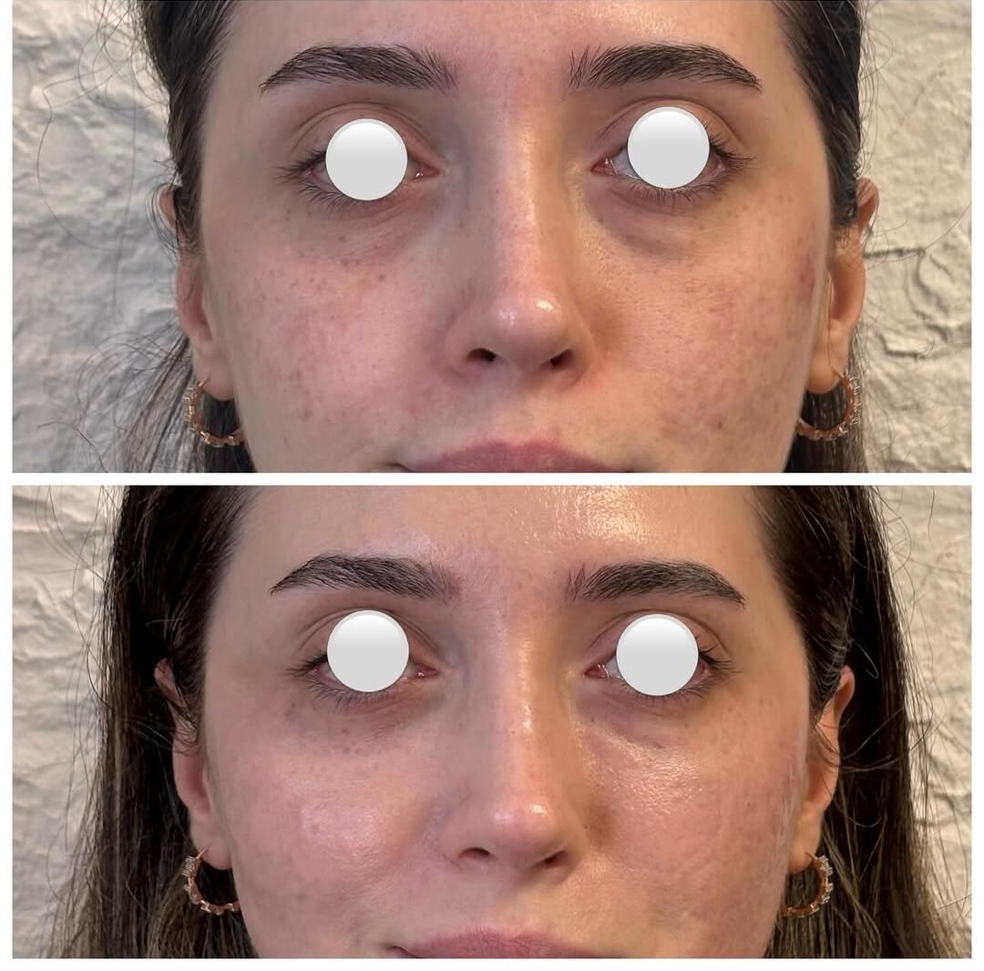 Göz altı ışık dolgusu — Dr. Cansu Şahin Dermatoloji