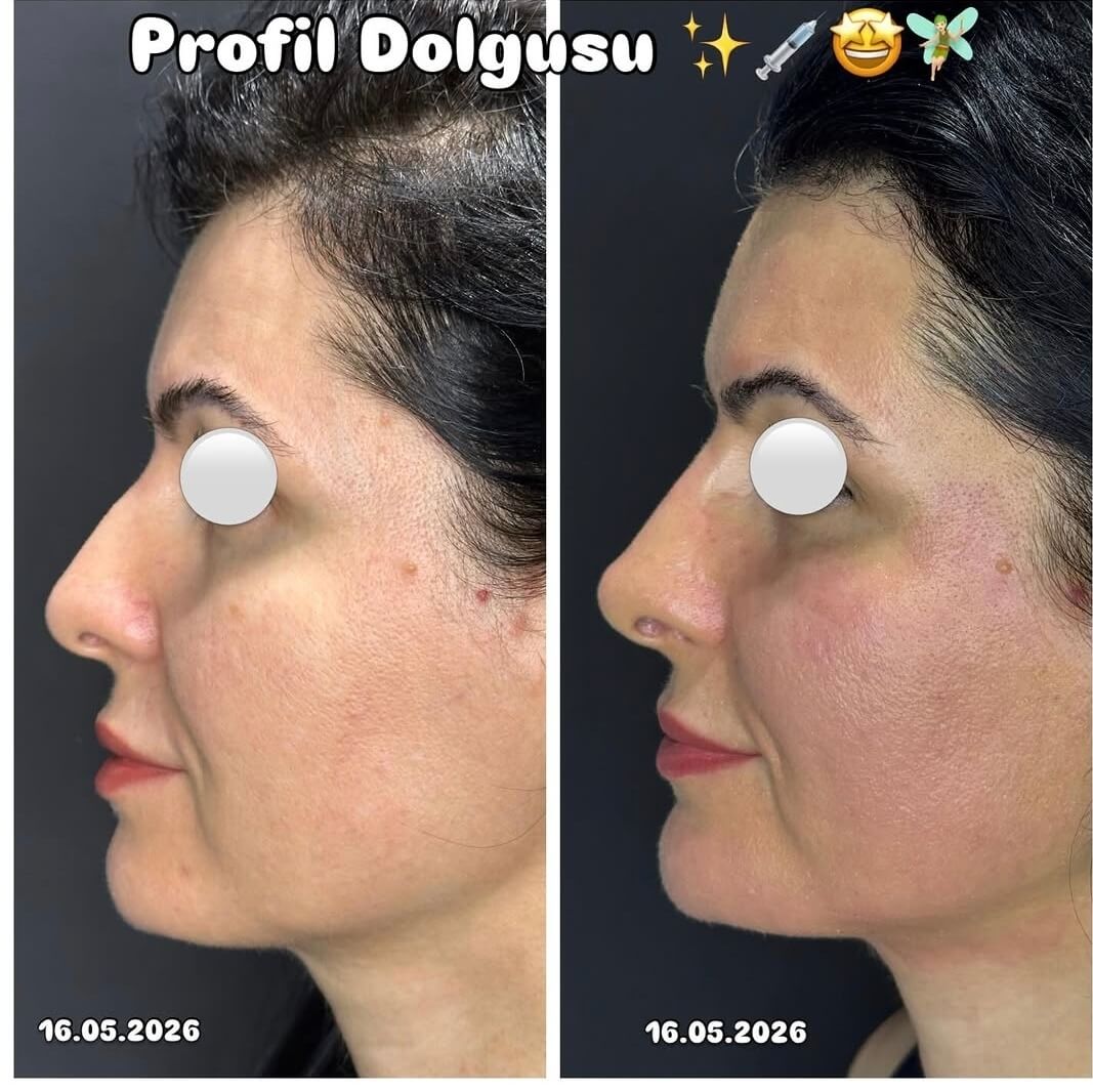 Profil dolgusu uygulaması — Dr. Cansu Şahin Dermatoloji