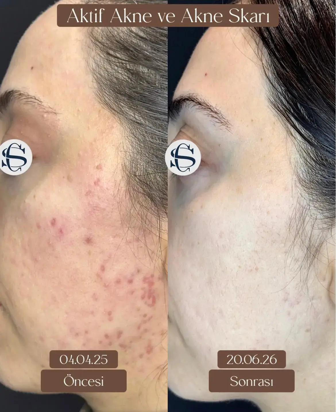 Karma izler — önce / sonra — Dr. Cansu Şahin Dermatoloji
