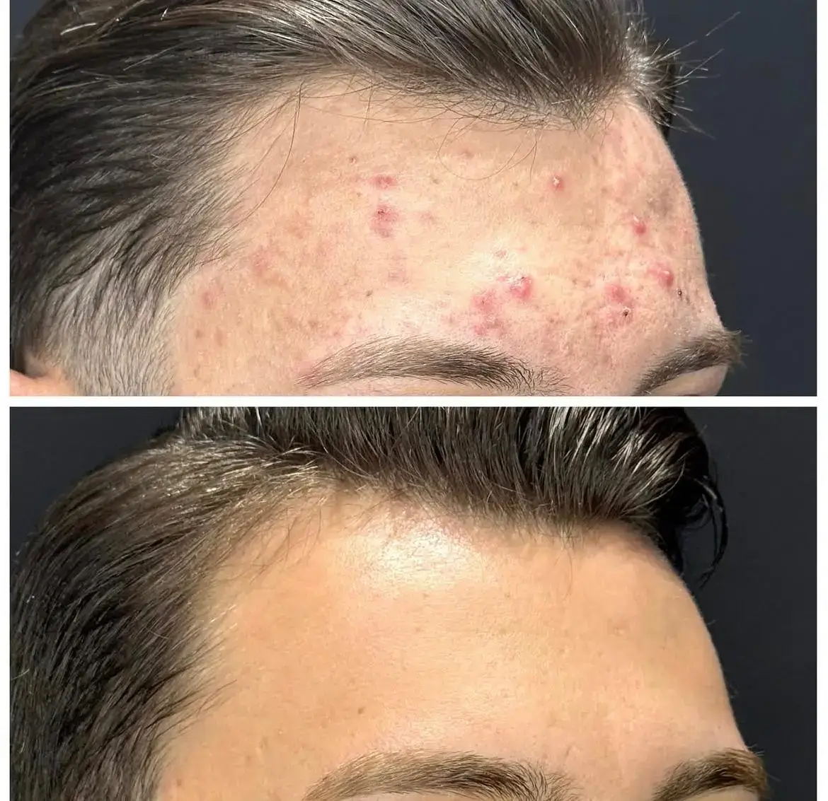 Akne izi tedavisi öncesi ve sonrası cilt analizi — Dr. Cansu Şahin Dermatoloji