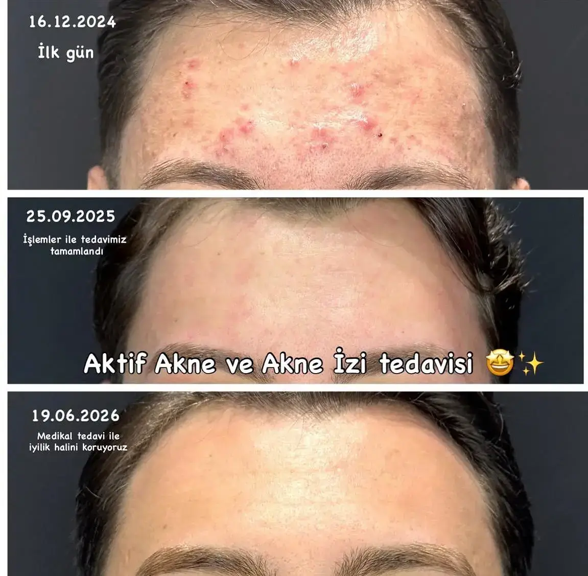 Skar izi — Dr. Cansu Şahin Dermatoloji