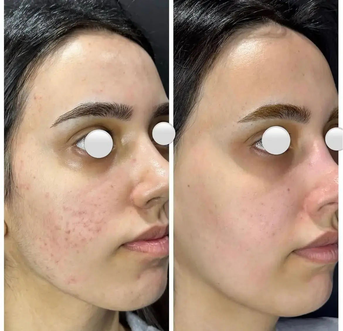 Yüzeysel skar — Dr. Cansu Şahin Dermatoloji